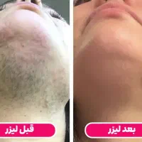 لیزر مو|خدمات آرایشگری و زیبایی|خوی, |دیوار