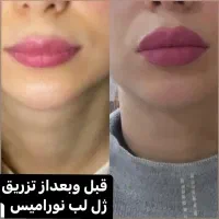 آف هفتگی تزریق ژل و بوتاکس و مزوژل جوانساز|خدمات آرایشگری و زیبایی|آمل, |دیوار