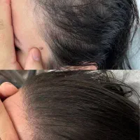 راه نجات کم‌پشتی مو با میکرواسکالپ|خدمات آرایشگری و زیبایی|دزفول, |دیوار
