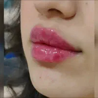 تزریقات ژل و بوتاکس