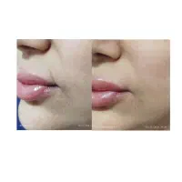 مزوژل جوانساز