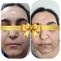 سرم جوانساز پوست صورت آریا|آرایشی، بهداشتی، درمانی|اصفهان, کوی امیریه|دیوار