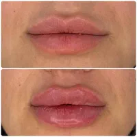 فیلر ‌بوتاکس ژل لب روسی کانتورینگ|خدمات آرایشگری و زیبایی|تهران, جمهوری|دیوار