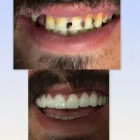 کامپوزیت دندان با قیمت های باورنکردنی