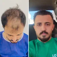 مرکز تخصصی کاشت مو و ابرو