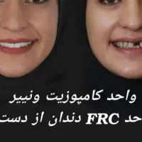 کامپوزیت دندان جشنواره ی تخفیفات تا شب یلدا|خدمات آرایشگری و زیبایی|رشت, معلم|دیوار