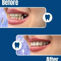 دندان مصنوعی اقساط و بیمه