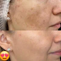 کرم ضدلک و روشن کننده|آرایشی، بهداشتی، درمانی|چاه داد خدا, |دیوار