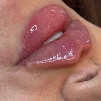 ژل فول فیس صورت زاویه . ژل لب متد جدید  تضمینی