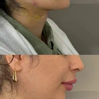 ساکشن شکم پهلو غبغب تزریق چربی ژل بوتاکس|خدمات آرایشگری و زیبایی|کرمانشاه, |دیوار