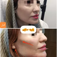 جشنواره تخفیف بوتاکس/ژل/آنزیم‌بینی/فیلرلب/فولفیس|خدمات آرایشگری و زیبایی|شیراز, زرهی|دیوار