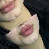 تزریق فیلر توسط پزشک برند رووفیل ۶۹۸ تومان|خدمات آرایشگری و زیبایی|خرم‌آباد, |دیوار