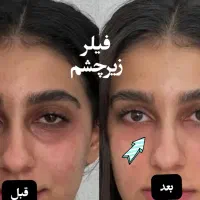 فیلر و بوتاکس و لیفت نخ+ آموزش (توسط پزشک)