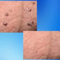 تض.م.ینی صدرصد زائ.ده هاتو ازبین ببر من.گوله hpv