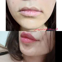 انجام تمامی خدمات فیلر و بوتاکس