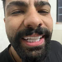 کامپوزیت دندان،عصبکشی دندان،روکش و لمینت جرمگیری