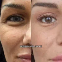 بلفاروپلاستی هر دو پلک فقط ۹.۹۰۰