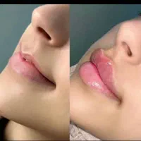 اف تابستانه زیبایی تزریق ژل، بوتاکس، پی ار پی|خدمات آرایشگری و زیبایی|اهواز, کمپلو جنوبی|دیوار
