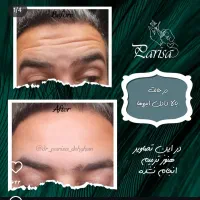 خدمات تخصصی تزریق بوتاکس فیلر بانوان و آقایون|خدمات آرایشگری و زیبایی|بیرجند, |دیوار