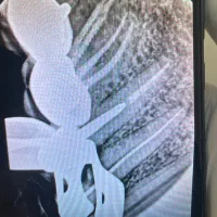 عصب کشی دندان ۴-۵ پایین و بالا فقط با قیمت مناسب