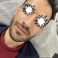 ژل وبوتاکس بلک فرایدی404(اقساط)(توسط پزشک)|خدمات آرایشگری و زیبایی|خرمآباد, |دیوار