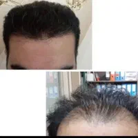 جشنواره کاشت مو فقط ۱۷ میلیون تومان