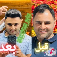 کاشت مو ابروبابروزترین متدروزدنیا