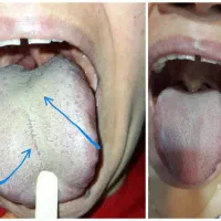 درمان قطعی کبدچرب|آرایشی، بهداشتی، درمانی|آمل, |دیوار