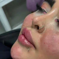 تخفیف ۵۰٪ خدمات زیبایی ژل .بوتاکس.مزو.آنزیم
