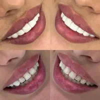 سلامت دندان طراحی خط لبخند آزاداقساطی بیمه تکمیلی