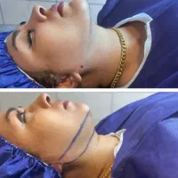 ساکشن غبغب و تزریق باسن و تزریق چربی