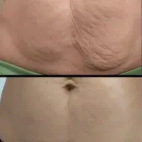 لاغری،لیفت‌بدن‌ورفع‌سلولیت(ترکیب‌هایفو وکویتیشن)