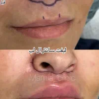 تزریق ژل و بوتاکس-چربی|خدمات آرایشگری و زیبایی|اهواز, کیانپارس |دیوار