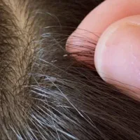 پاکسازی شپش از سر دریک جلسه