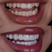 کامپوزیت دندان