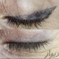 پاک کردن تتو با لیزر کک و مک برداشت خال|خدمات آرایشگری و زیبایی|مشهد, شهید فرامرز عباسی|دیوار