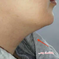 لیفت وجوانسازی قوی صورت|خدمات آرایشگری و زیبایی|رشت, گلسار|دیوار