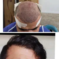 کاشت تخصصی مو وابرو|خدمات آرایشگری و زیبایی|یاسوج, |دیوار