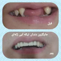 ساخت انواع دندانهای مصنوعی ژله‌ای باضمانت ساخت