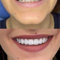 کامپوزیت. لمینت .عصب کشی .مروارید