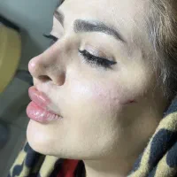 اصلاح تخصصی فرم بینی بدون عمل(دکتر زرین) فیلرنخ ژل|خدمات زیبایی و سلامت|تهران, الهیه|دیوار