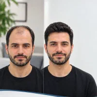 کاشت مو به صورت اقساطی+۲۰ درصد تخفیف