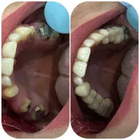 عصب‌کشی فقط ۴ م/ جشنواره دندان‌پزشکی/بیمه تکمیلی