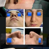 جشنواه ویژه  خدمات   عمل بینی لیپو ساکشن|خدمات آرایشگری و زیبایی|اهواز, کیانپارس |دیوار