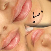 فیلر و بوتاکس وانزیم فیلر|خدمات آرایشگری و زیبایی|قم, دروازه چوبی|دیوار