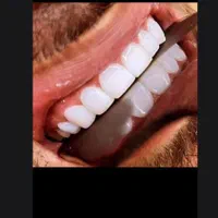 کامپوزیت زیبایی دندان باچک درمحل زیباجو فکی۷میلیون|خدمات آرایشگری و زیبایی|رشت, گلسار|دیوار