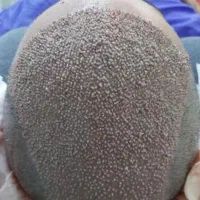 کاشت مو طبیعی