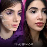 نیاز به مدل برای تزریق فیلر فول فیس(لب،زاویه،چونه)