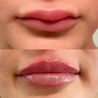تزریقات و خدمات زیبایی کلینیک بوتاکس ژل مزو PRP|خدمات آرایشگری و زیبایی|کرمانشاه, |دیوار