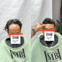 پروتز مو جایگزین کاشت مو